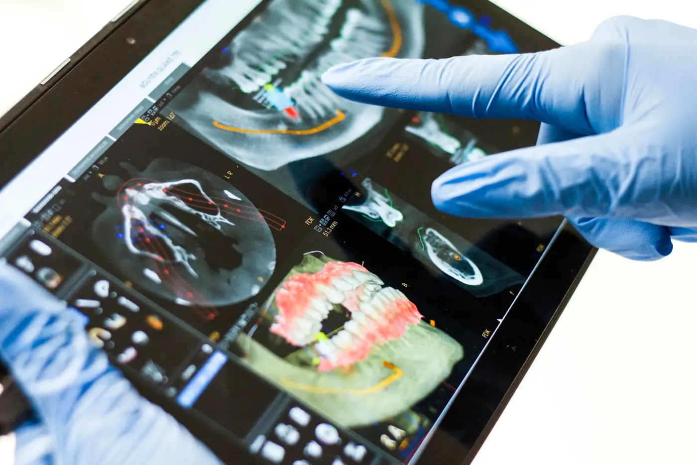 Glove pointing at a dental x-ray. Illustrative photo.